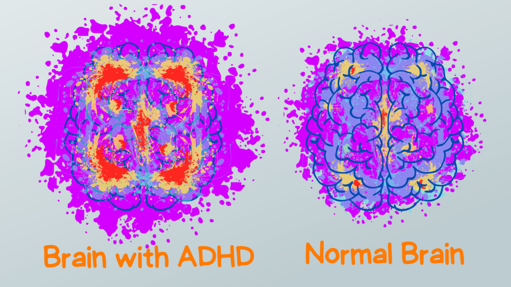 Brain with ADHD vs Normal Brain