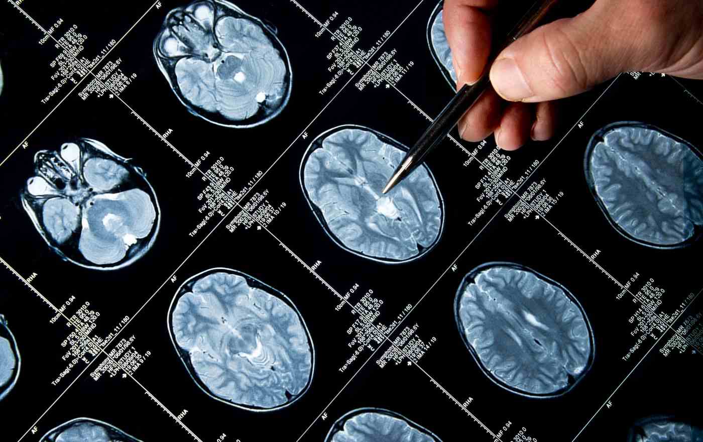 How Brain Scans Diagnose ADHD